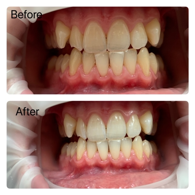 Dental deals teeth whitening